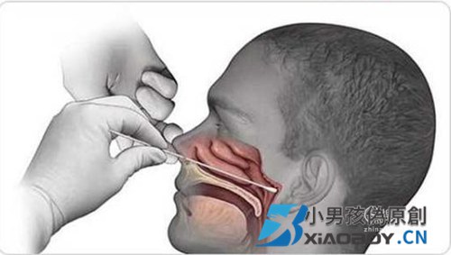 基因检测-一次性鼻咽拭子采样流程