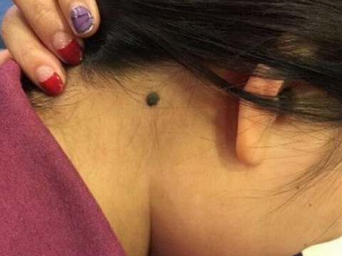 脖子左侧有痣的女人代表什么