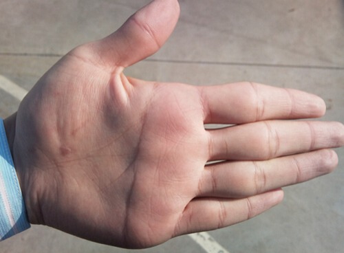 断掌是怎么回事