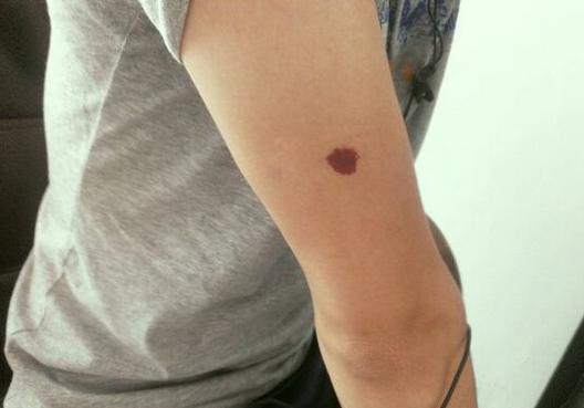 手臂上有胎记,好吗