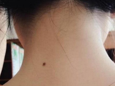 颈部长痣的静脉分析