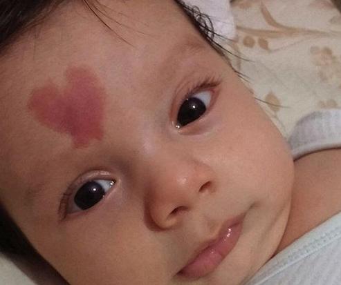 如何根据胎记位置算命？