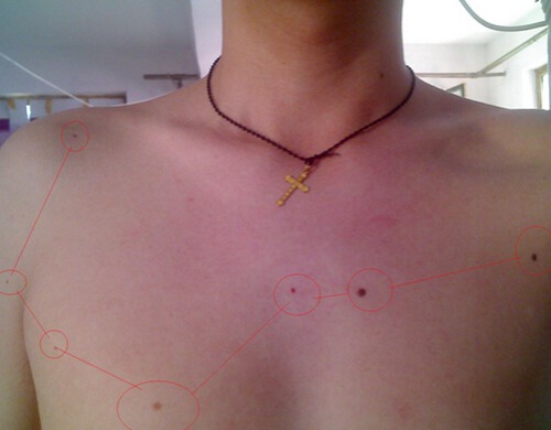 胸口有痣，好吗