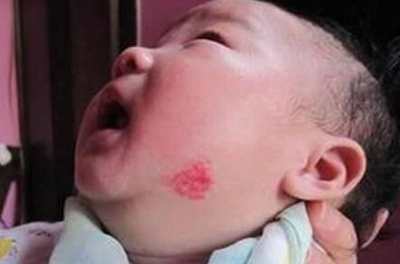 脸上的胎记是什么意思