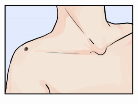 男人肩膀痣相图解 肩膀上有痣代表什么