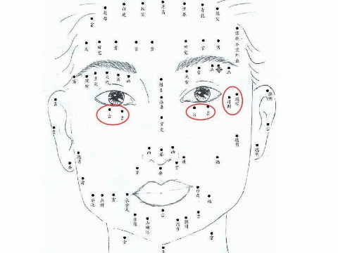 女性眼睛周围痣插图