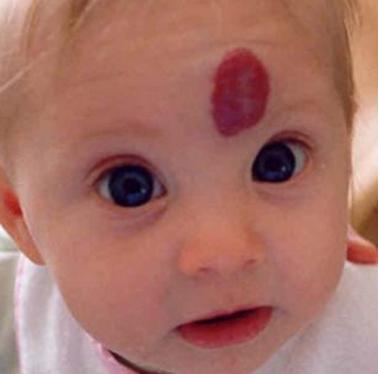 红色胎记的危害