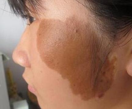 胎记算命胎记是好是坏