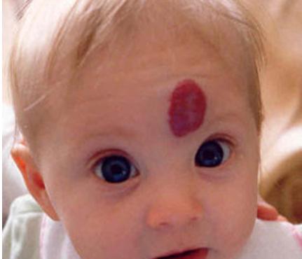 如何根据面部胎记算命？