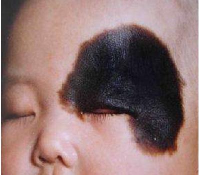 黑色胎记的形成黑色胎记算命