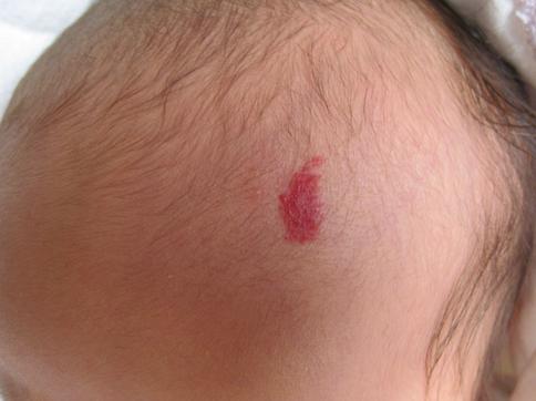 当你额头上有胎记时会发生什么