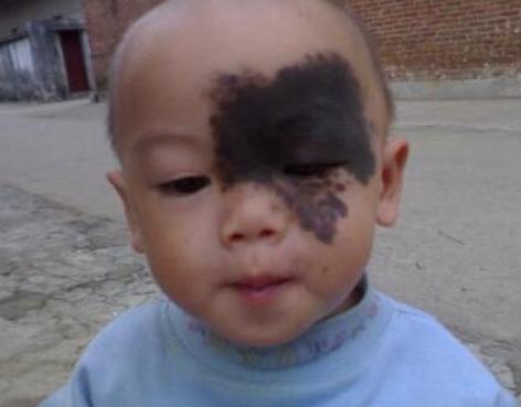 胎记形成的因素胎记算命