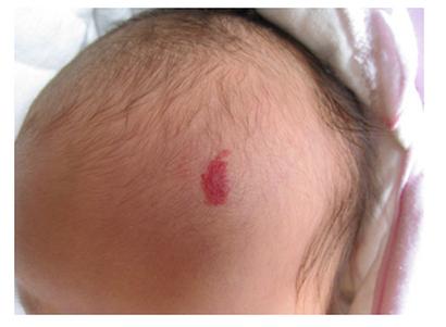 红色胎记是什么意思？