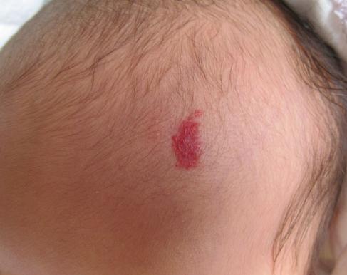 胎记的形成因素如何在胎记中算命