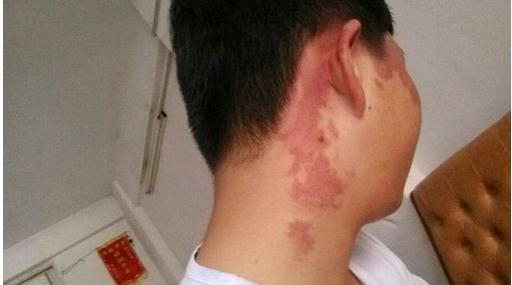 胎记是怎么产生的？