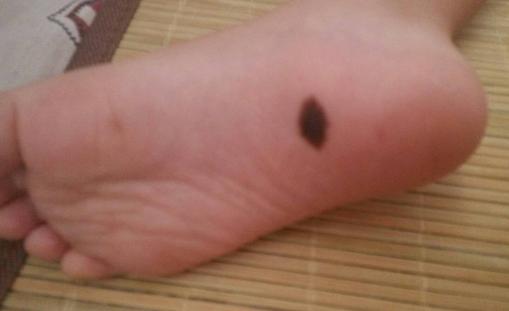 脚底有胎记怎么样